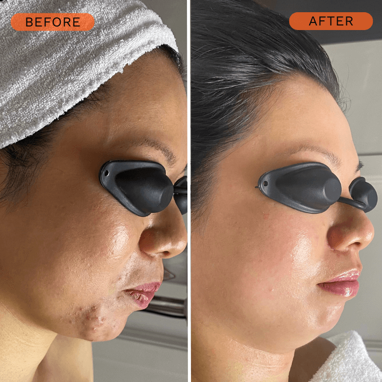 Before and after results for post-acne marks and uneven skin texture