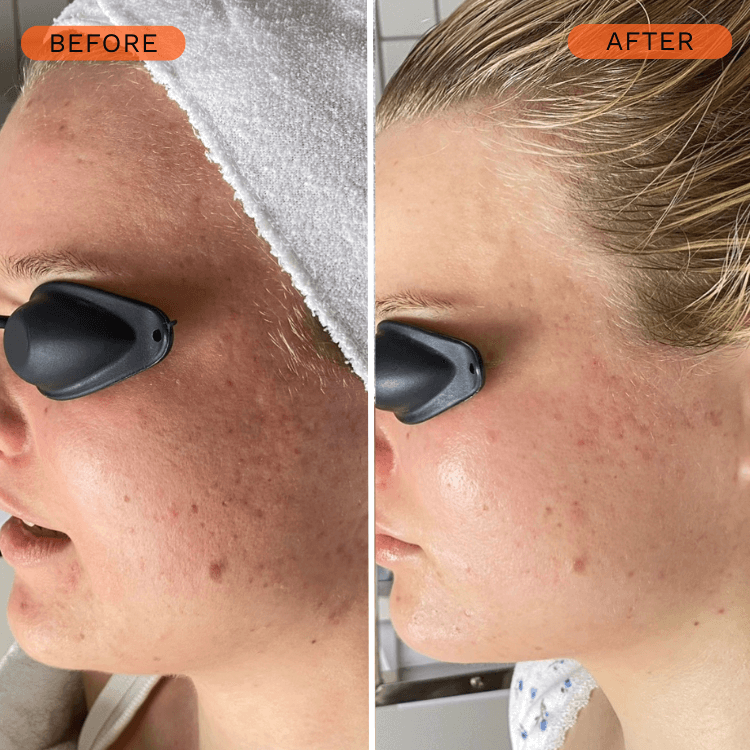 chemical peel results for acne scars