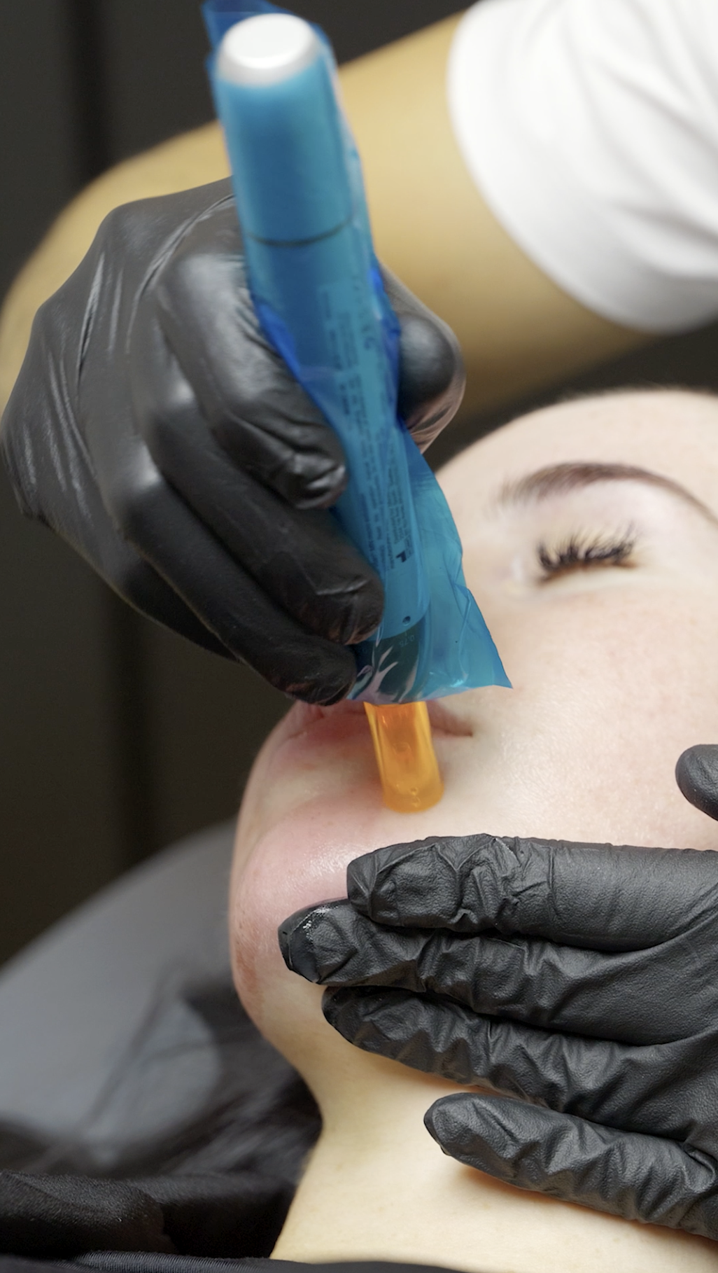 a professional corrective microneedling treatment being received at a cheltenham skin clinic Nu-Clear
