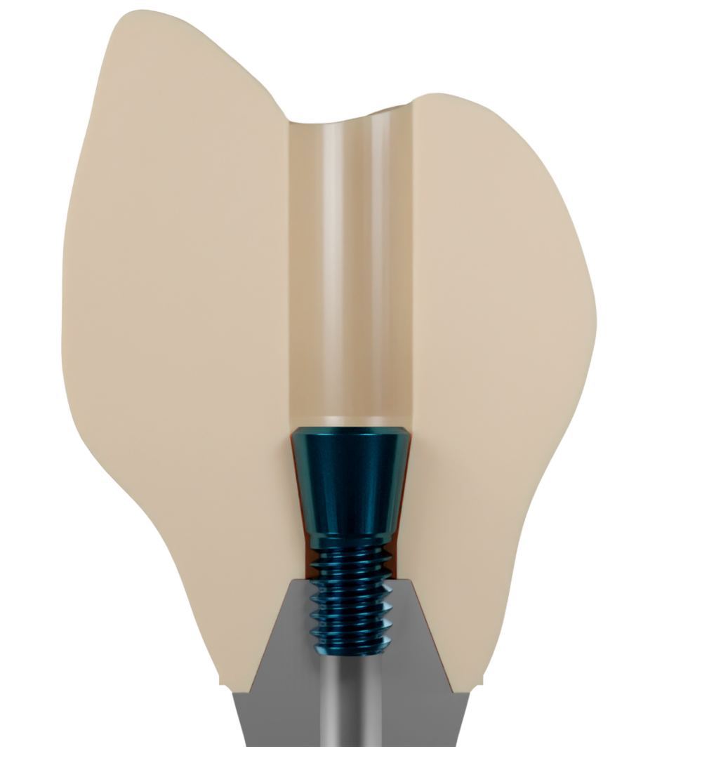Nexus iOS Immediate Full-Arch Dental Prosthetics — Nexus iOS