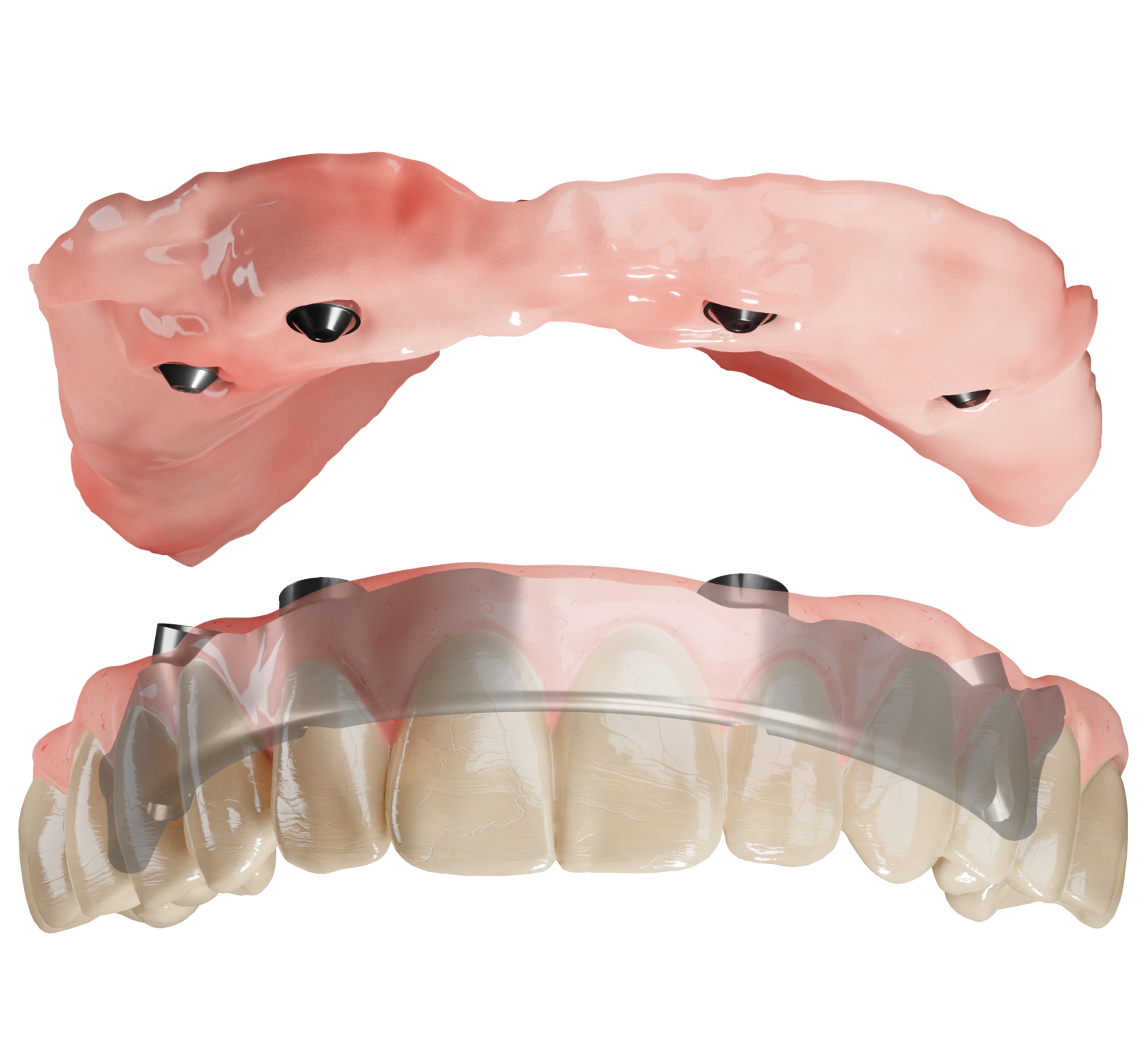 Nexus Scan Gauges and a validated intraoral scanner is all you need to  digitize your full-arch restoration workflow. When this data is…