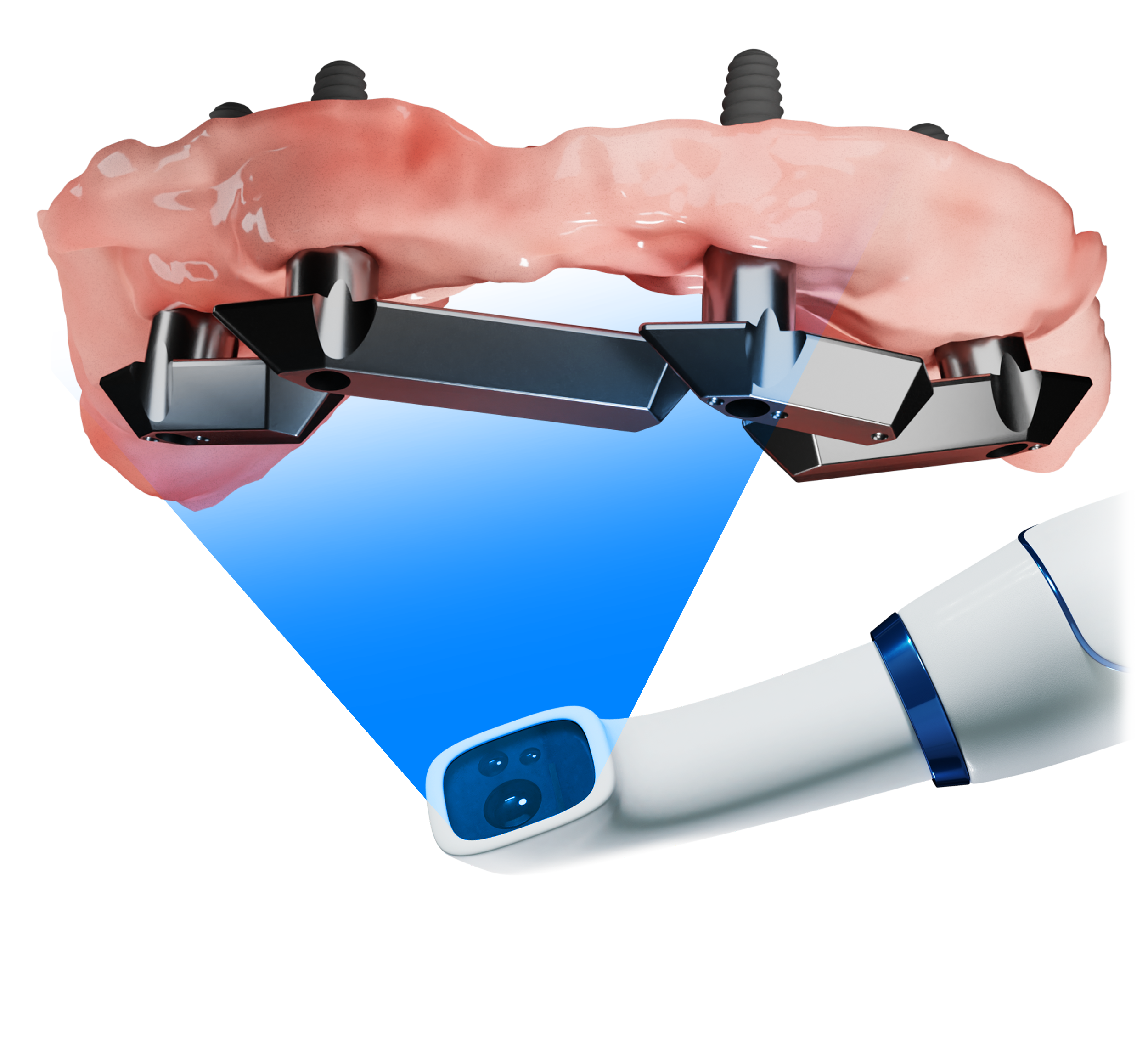 Nexus Scan Gauges and a validated intraoral scanner is all you need to  digitize your full-arch restoration workflow. When this data is…