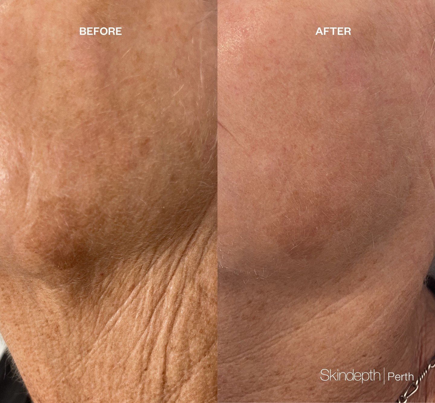 Pigmentation be gone 🪄 Incredible results by our @skindepth_perth team ⁠
⁠
Skin concerns: Skin tone / pigmentation⁠
Treatments: 3 sessions of IPL for pigmentation and updated at home regime including vitamin A and skin lightening serum. ⁠
⁠
Before i