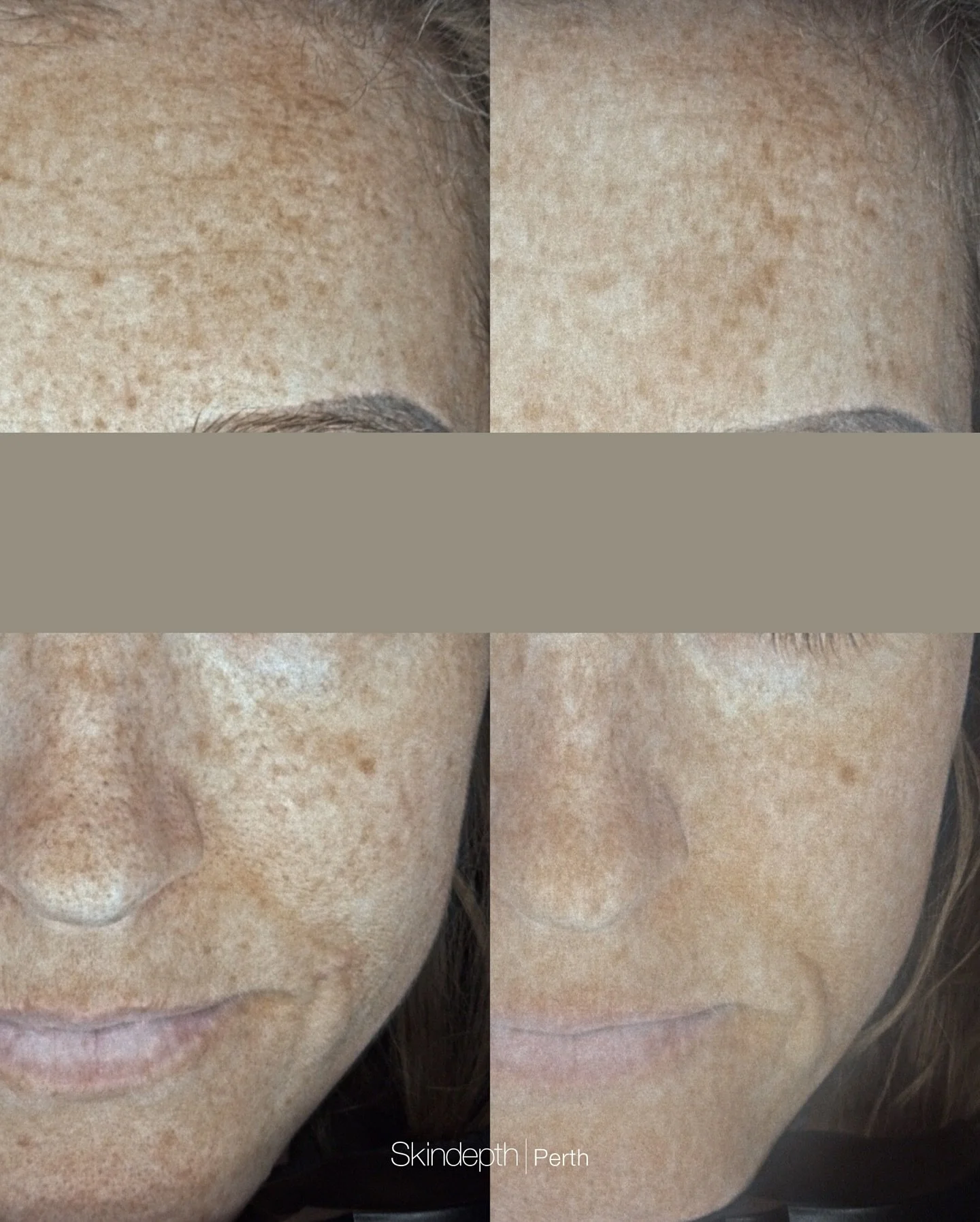 Pigmentation Journey by #skinbychantel ⁠
⁠
At Skindepth, we target pigment at the source. Our targeted treatment plan for our client has successfully addressed the underlying pigmentation &amp; redness with a combination of: ⁠
⁠
- IPL rejuvenation to