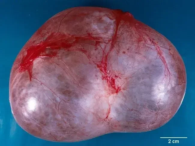 found image of cyst