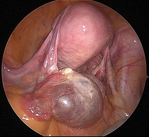  ovarian cyst