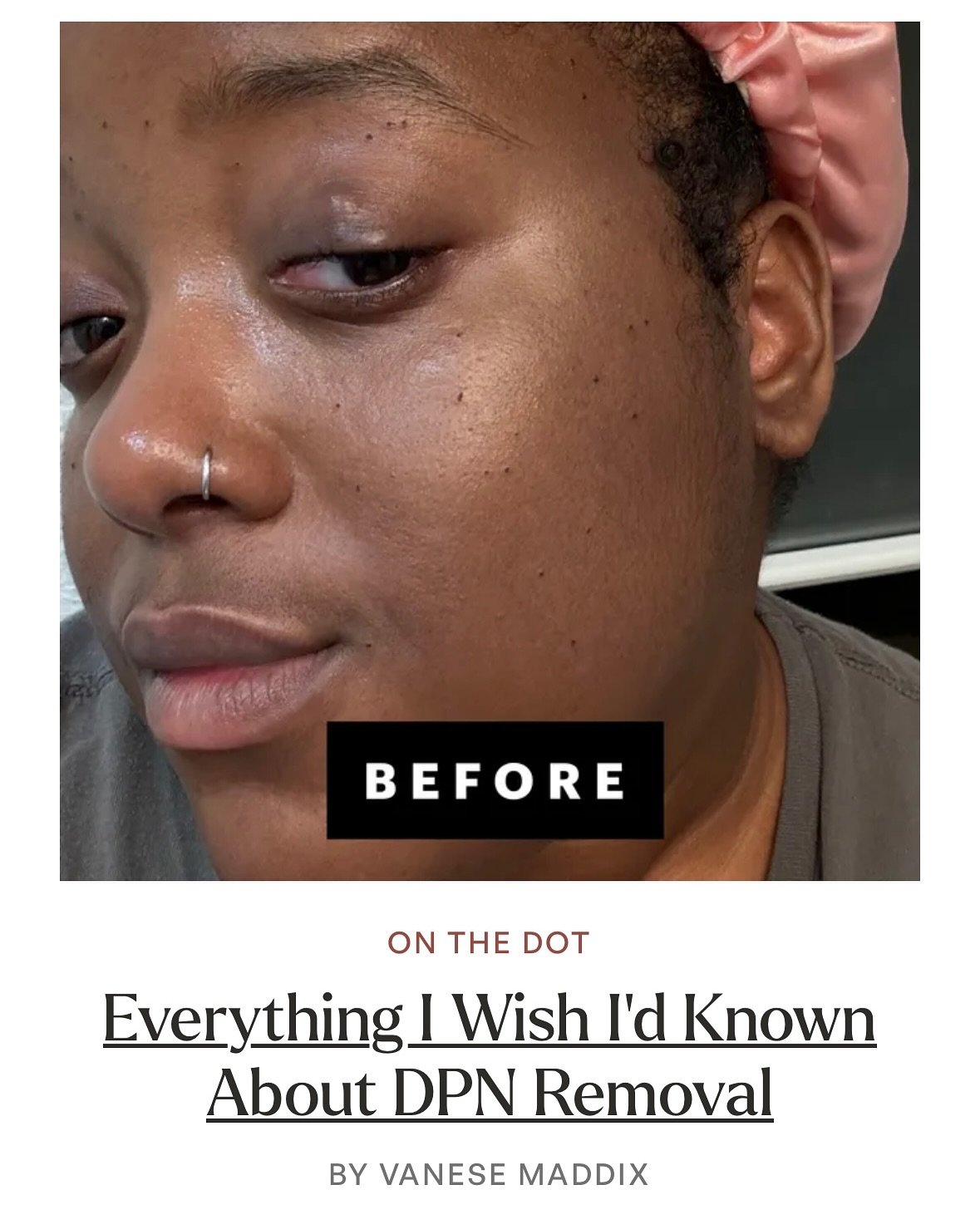 Baby&rsquo;s first @allure byline and it&rsquo;s all about my DPN removal. Thank you to @dangeneskin for my removal and for being so informative from start to finish. Along with some great expert commentary by @dr.coreyhartman and @drnaanaboakye 

Th