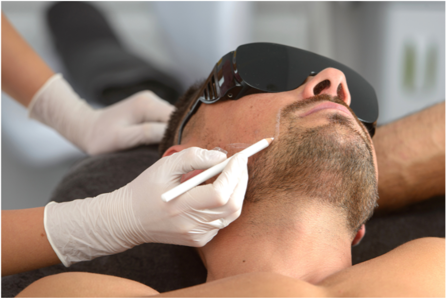 Men's facial laser hair removal beard and neck Beaverton Oregon
