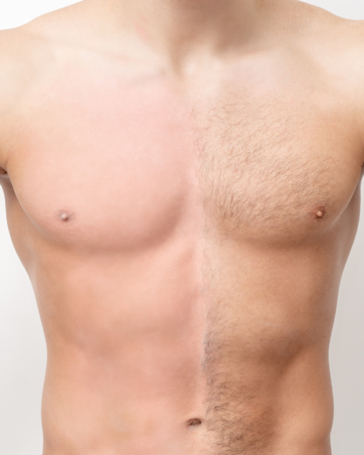 Men's laser hair removal chest and stomach treatment Beaverton OR
