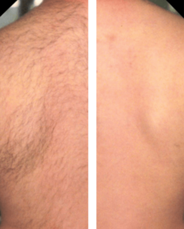 Men's laser hair removal back treatment Radiance Laser Cosmetics Beaverton