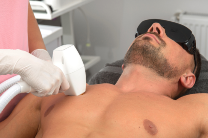Men's full body laser hair removal treatment areas Radiance Laser Cosmetics