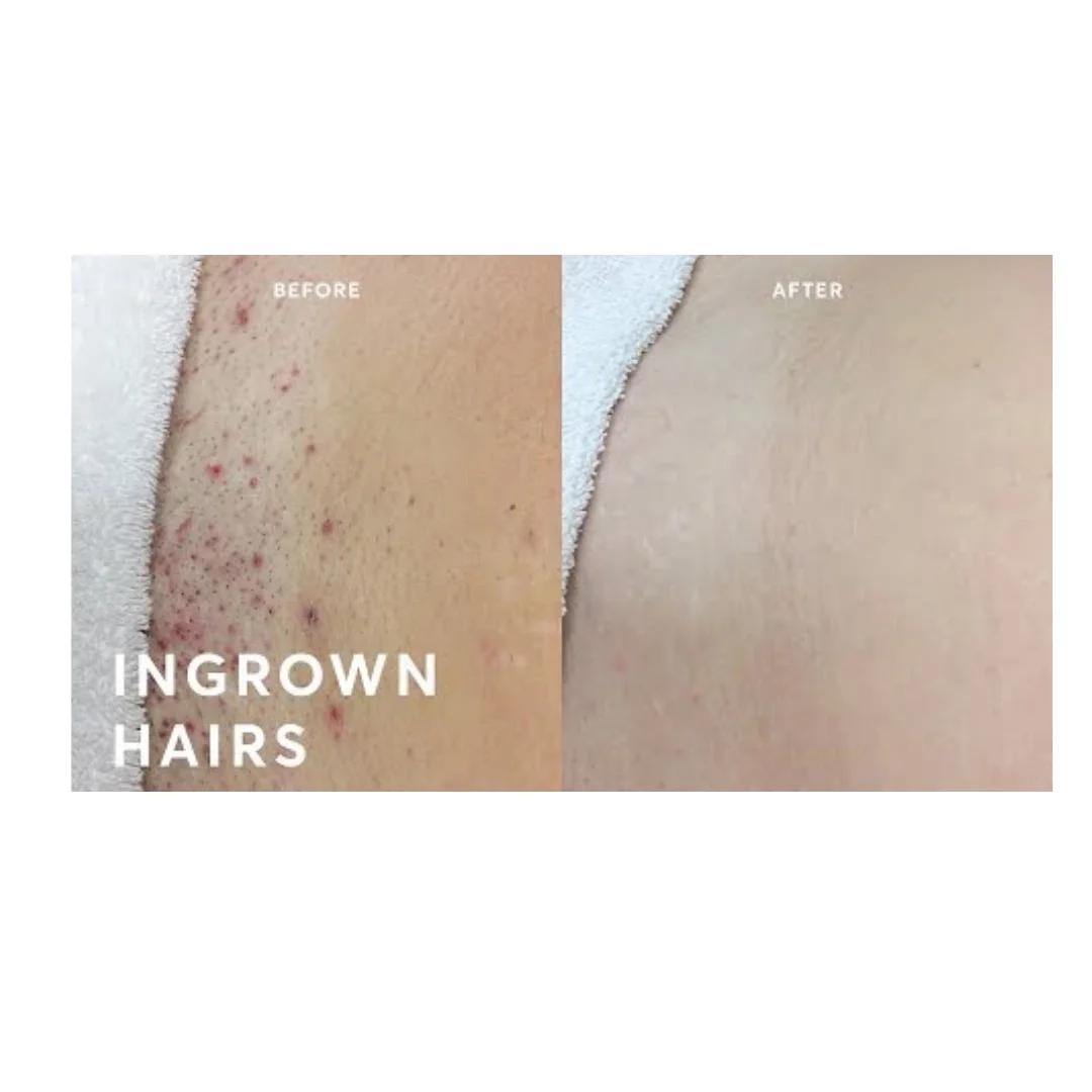 Women's underarm laser hair removal Beaverton Oregon.webp