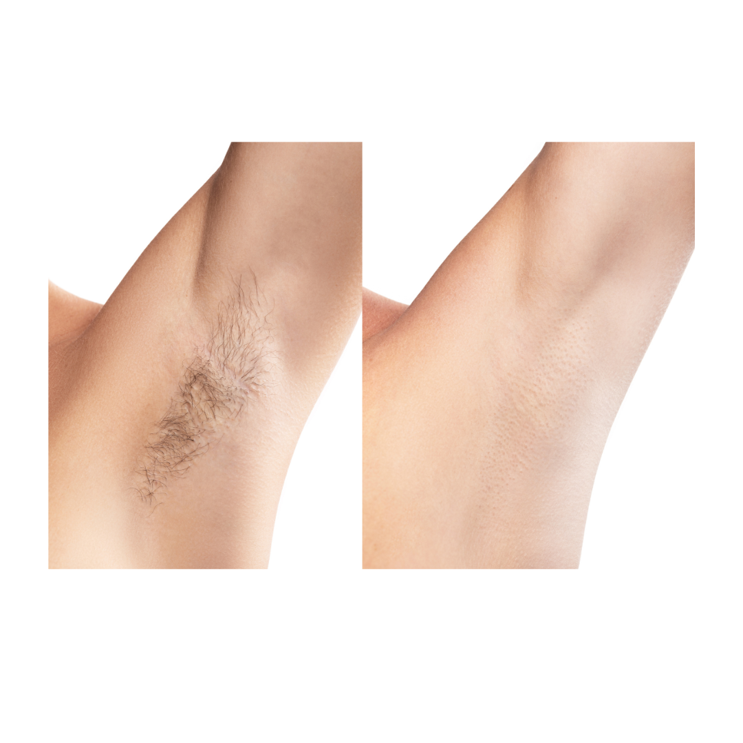 Womens under arm service Radiance Laser Cosmetics.png