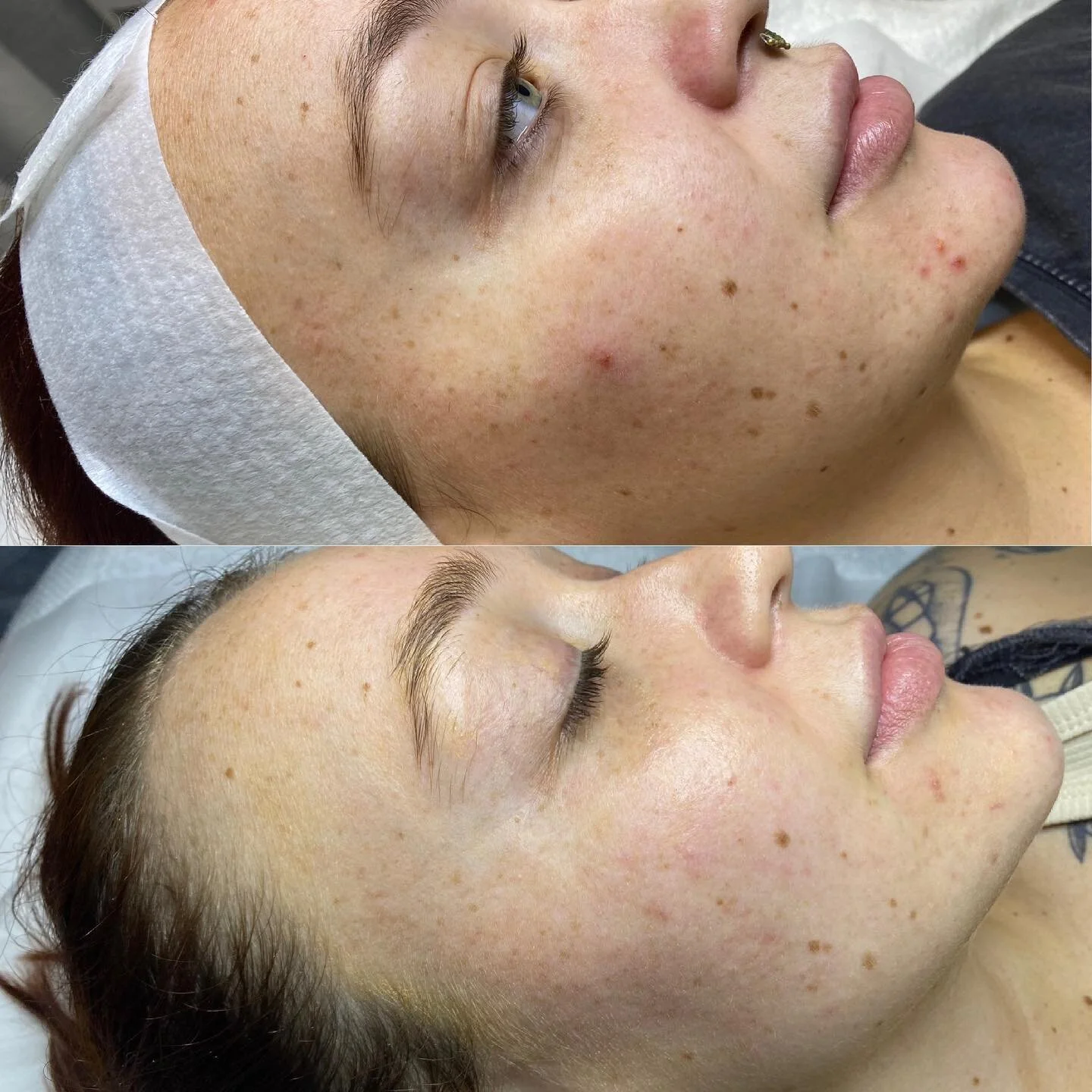 Look at the GLOW UP! 

These photos are taken 3 weeks apart. We have started a personalised treatment plan for this doll and have added in some brightening products to her home care! 

What an amazing result so far 🤍🤍🤍 

Our June sales are ending 