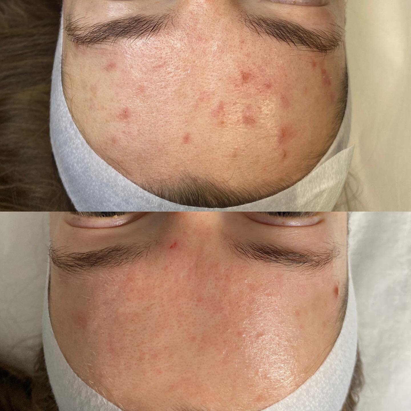 Before 💫 After - 2 WEEKS APART ⭐️ RESULTS After 1 ENZYME PEEL + LED treatment and using prescribed home care products. 

Stay tuned for more results over the coming weeks as we have just started the 6 WEEK BOOT CAMP! 

Whose ready to start their ski