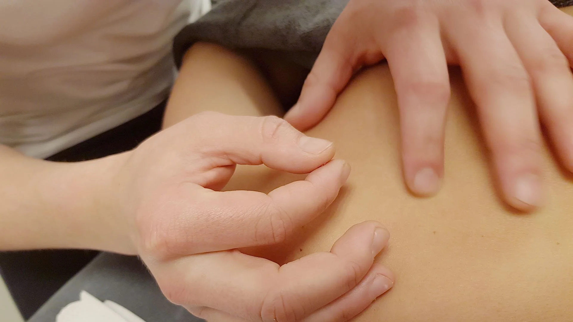 Dry Needling