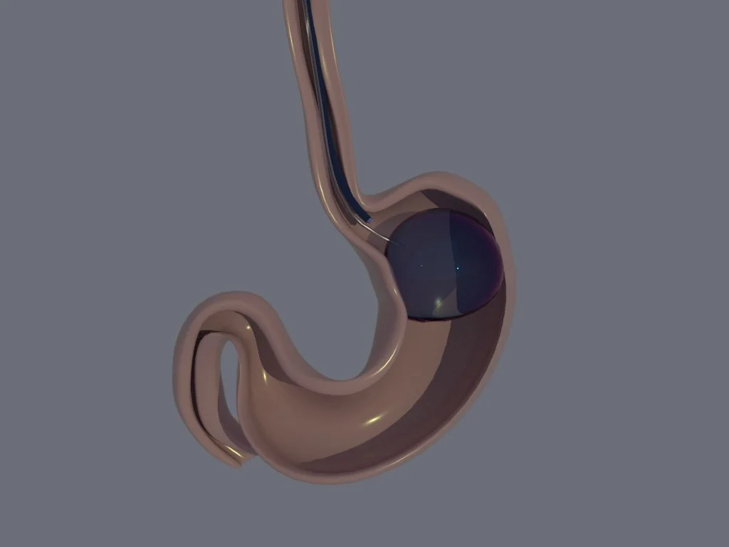 Intragastric Balloon Procedure
