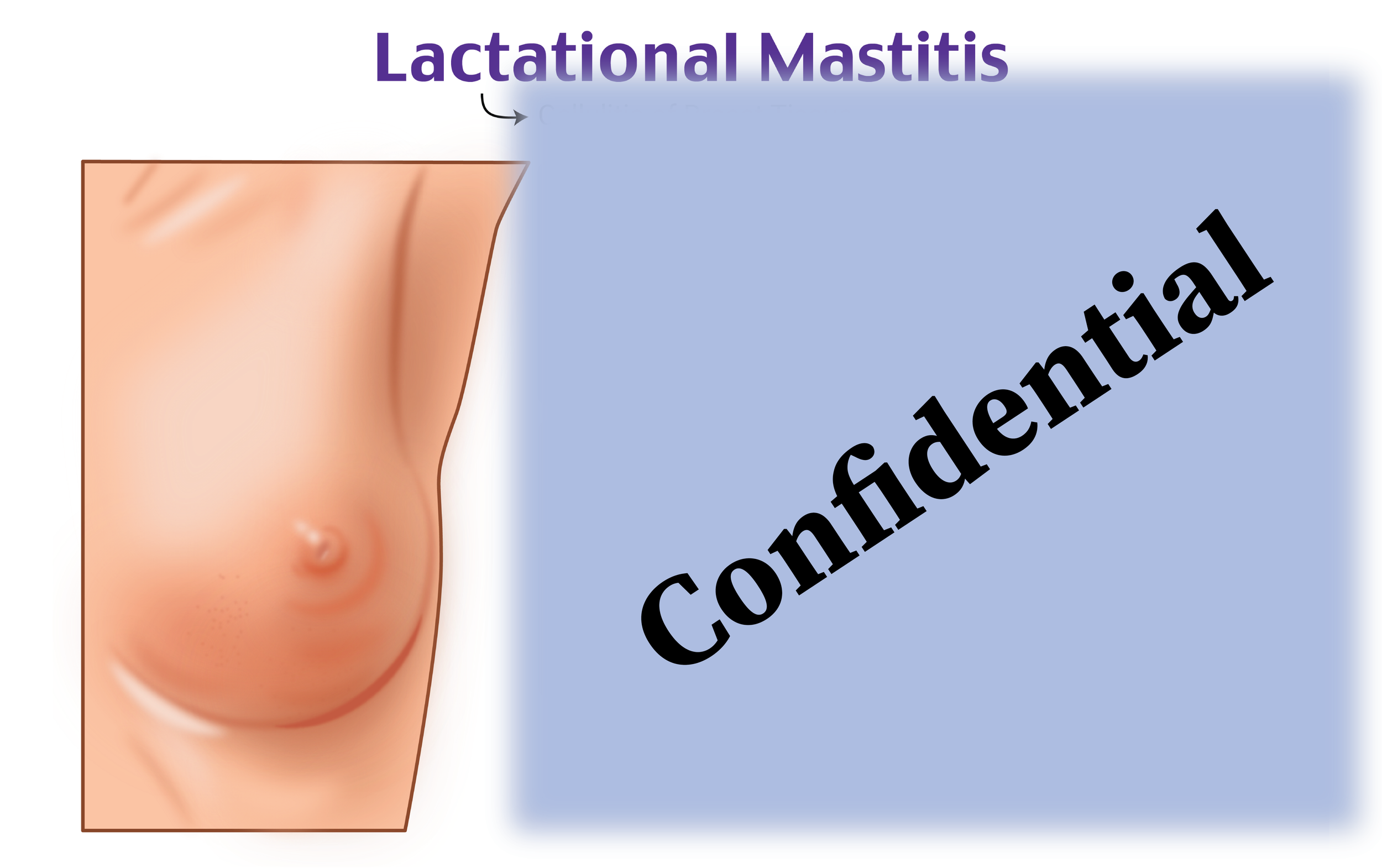 Lactational Mastitis