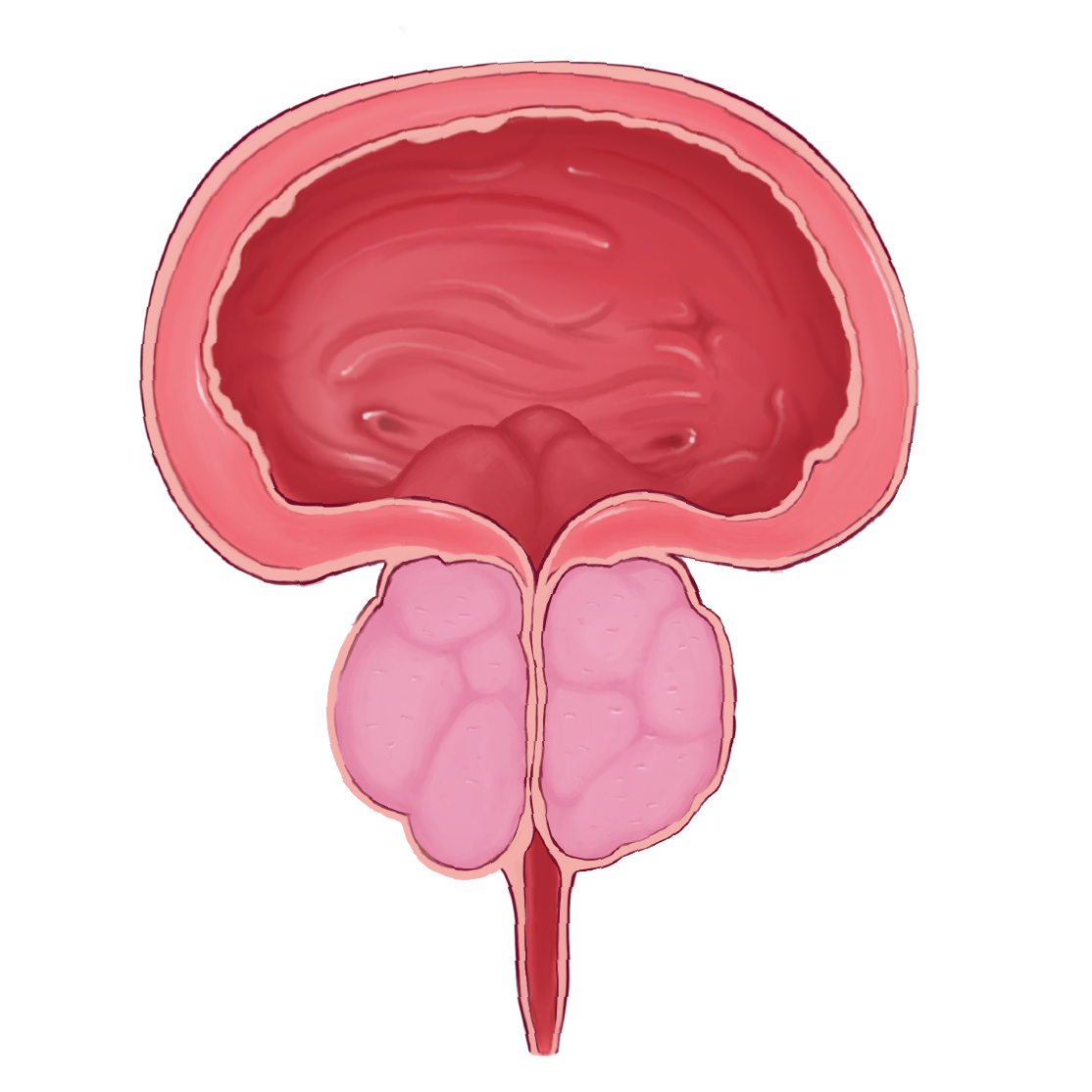 Benign Prostatic Hyperplasia