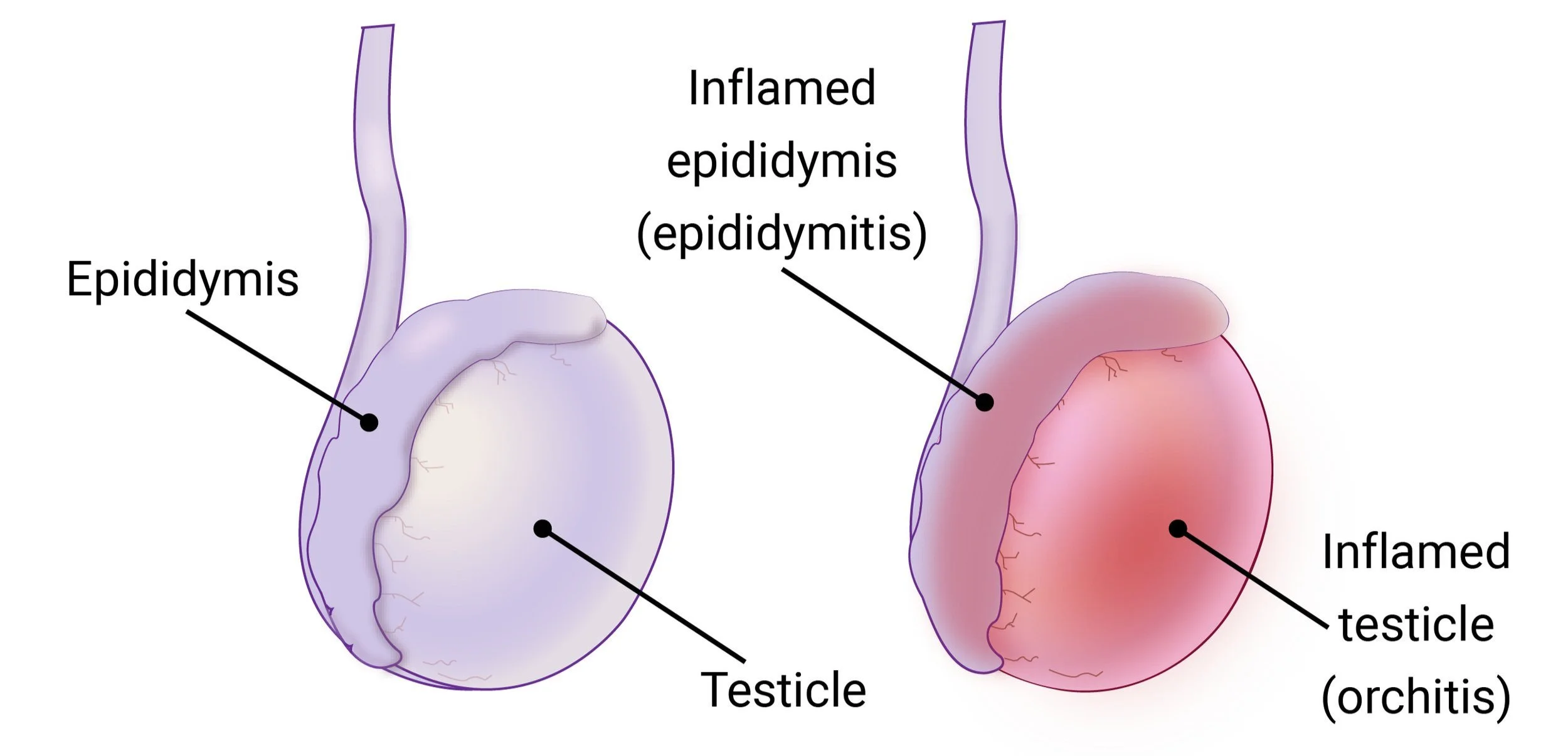 Epididymo-Orchitis