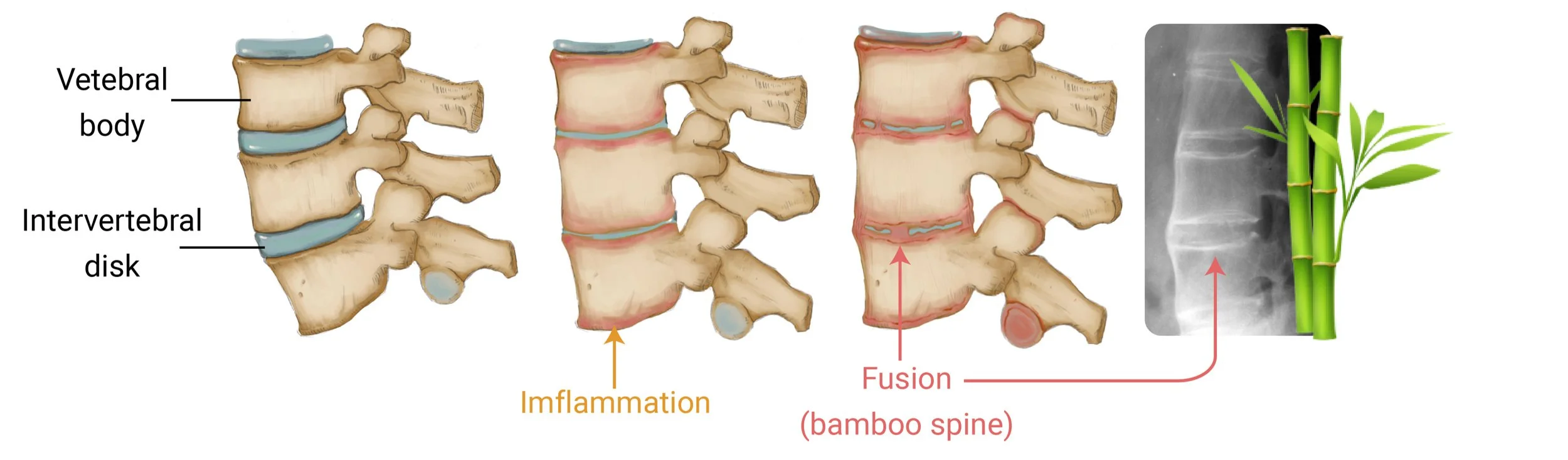 Ankylosing Spondylitis