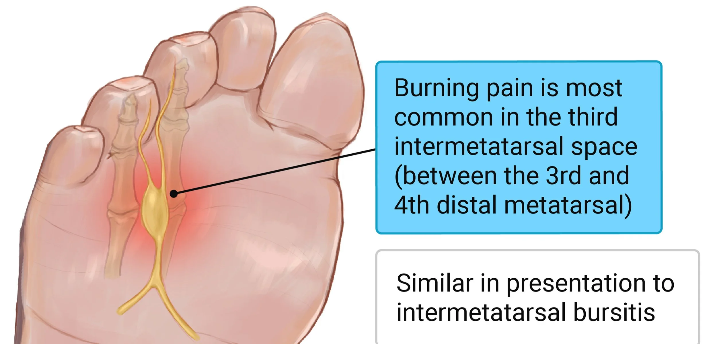 Interdigital Neuroma
