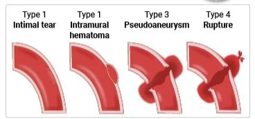Different Types of Vaccines