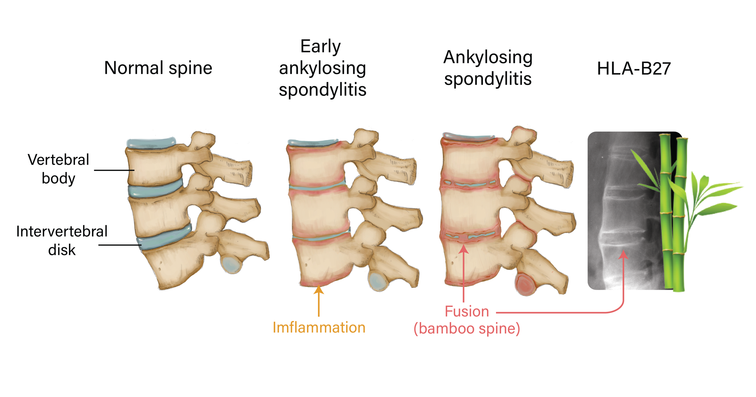 ankylosing spondylitis @8x.png