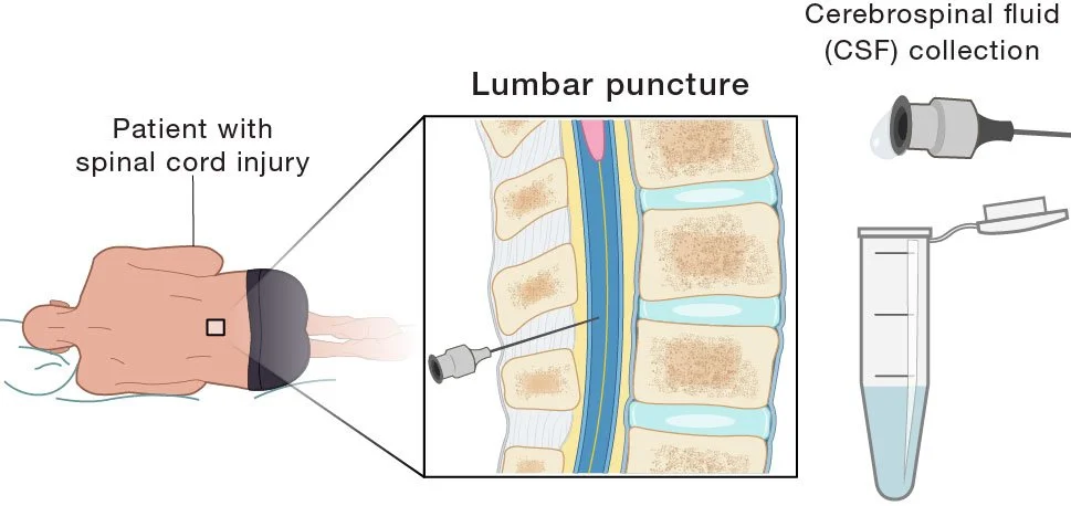 lumbar puncture.jpg