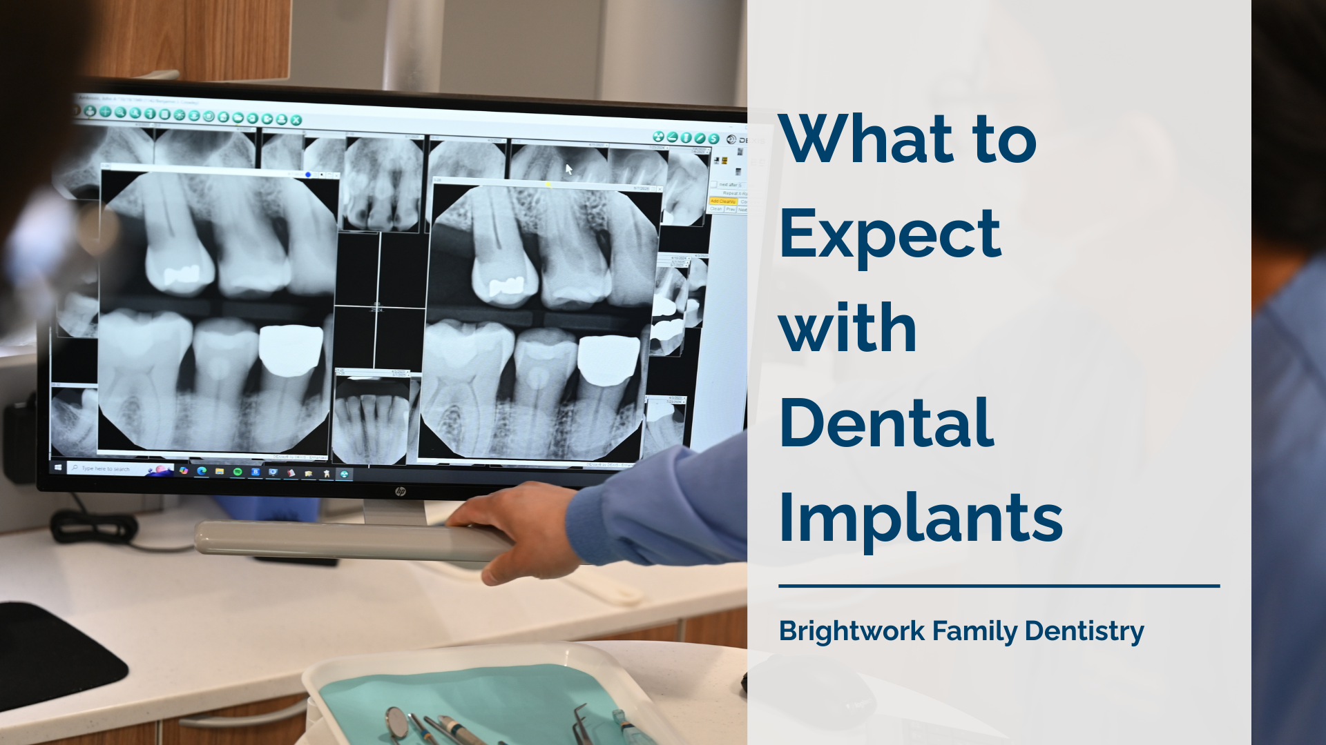 What to Expect With Dental Implants