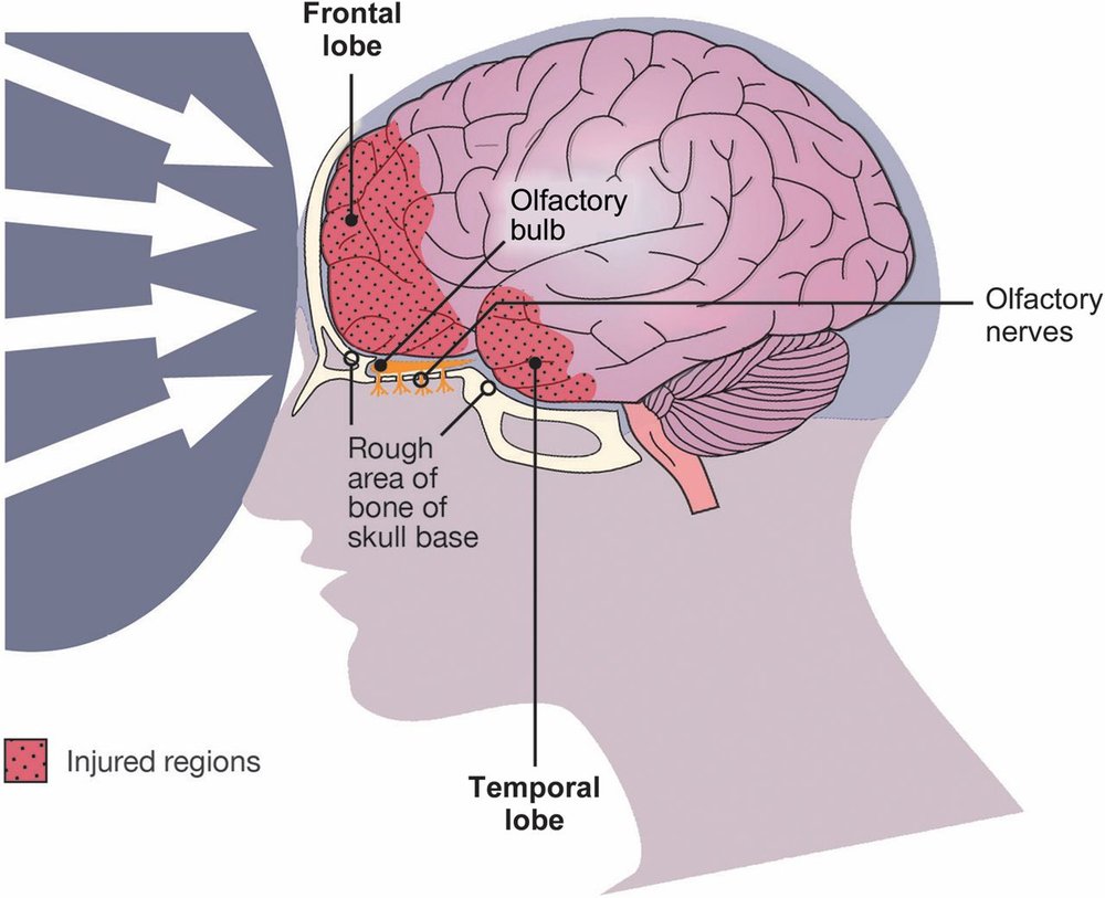 Diagram showing how brain injury affects the olfactory bulb which results in smell loss.