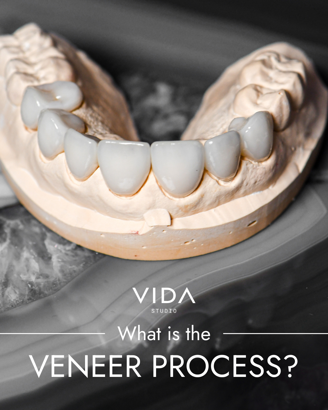 What’s the Veneer Process.png