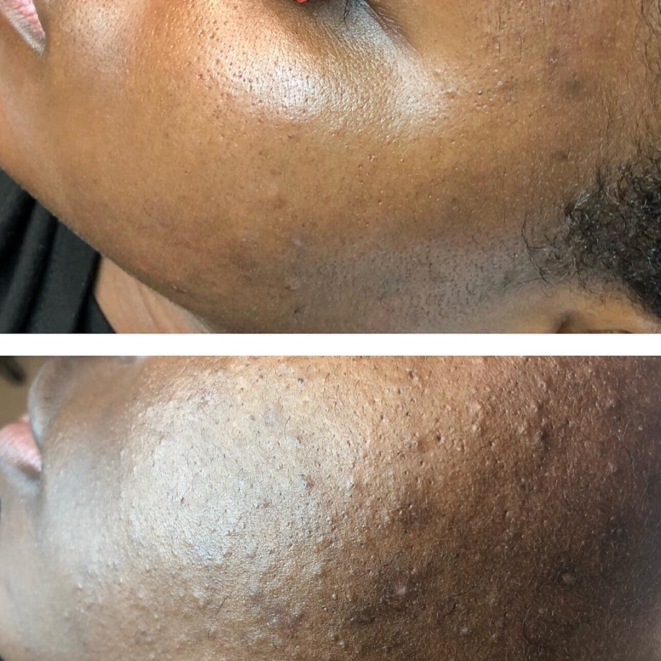 Memorial Skin Care Services - Acne Boot Camp