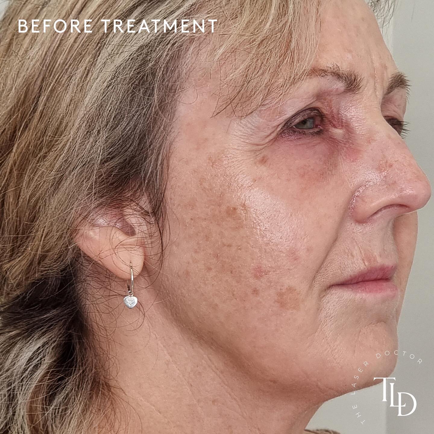 Swipe to see her skin after our Signature Carbon Facial treatments ⏭ 

Carbon Facial + Consistency = Results 🙌 We're stoked to see the improvements in our wonderful clients' skin texture, overall skin tone and complexion as a result of consistent tr