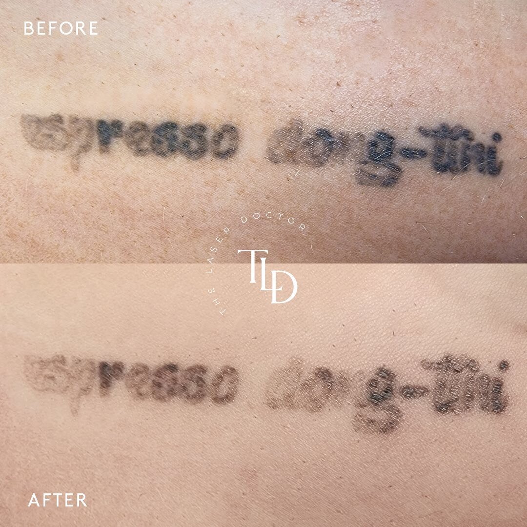Our Q-Switched Nd-YAG laser is one of the safest and most effective method for getting rid of your old ink. The non-invasive laser shoots a concentrated laser beam into the tattoo that breaks up and separates the ink particles embedded in the skin. W