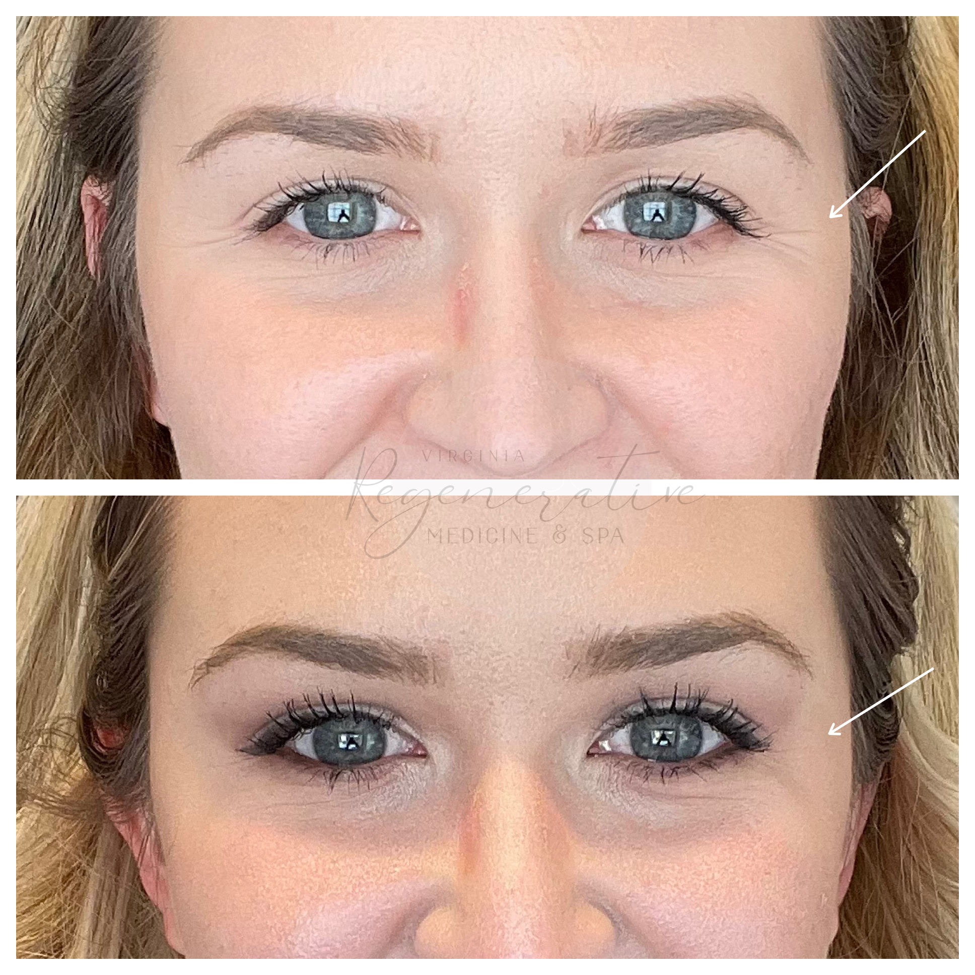 Xeomin Crows Feet 2 Weeks Before and After