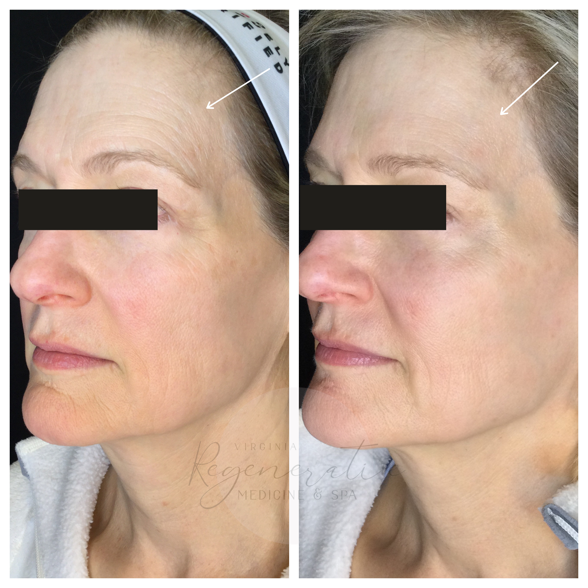 Microneedling with Exosomes Before and After 2 Weeks Apart
