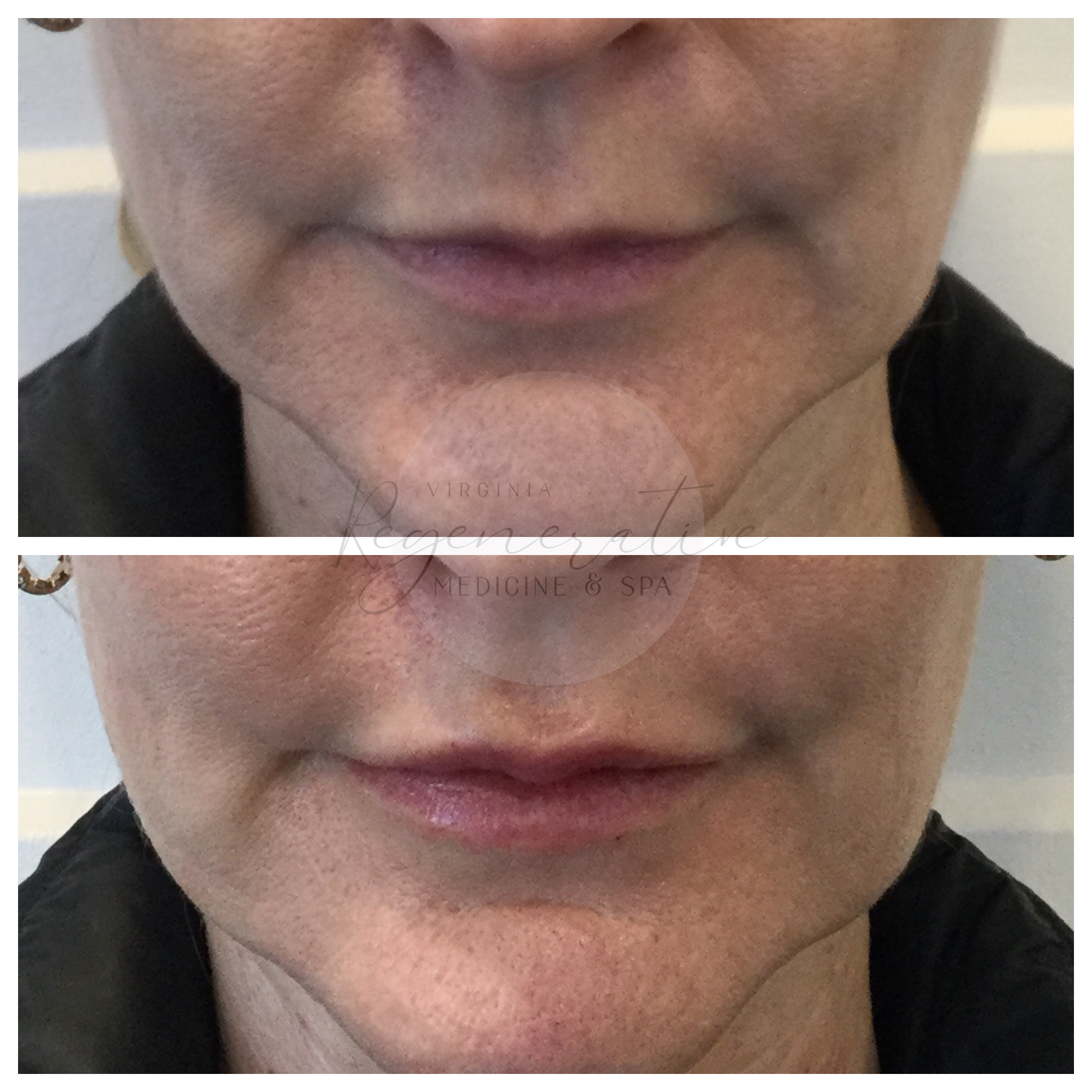 Juvederm Lips Immediate Before and After