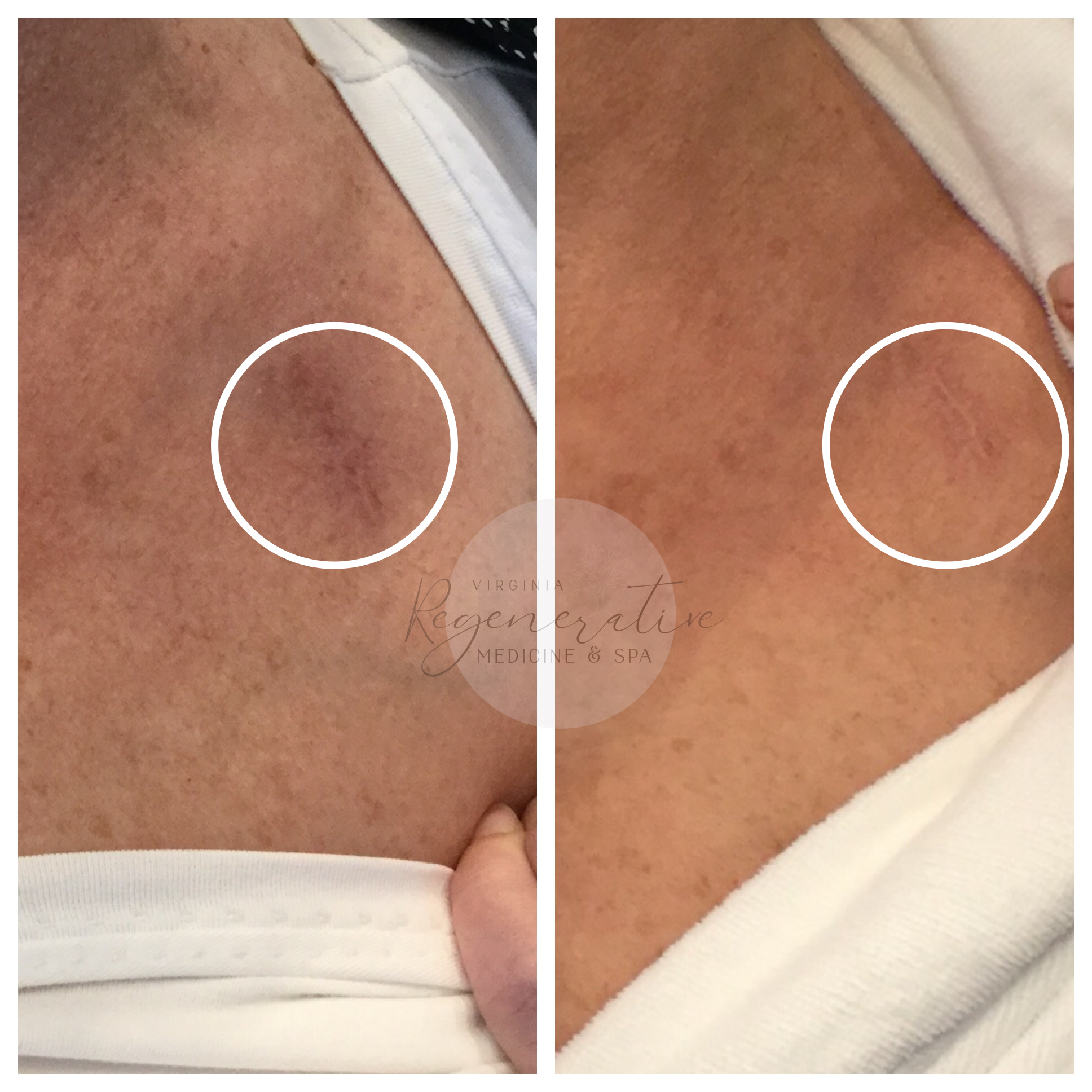 Microneedling with Exosome Scar Revision