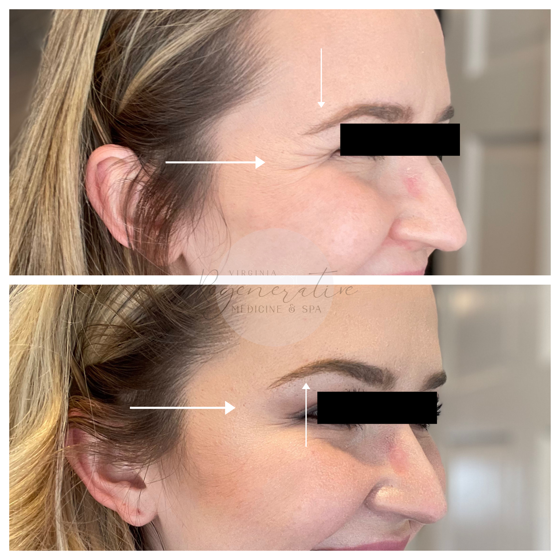 Xeomin Brow Lift and Crows Feet 2 Weeks Before and After