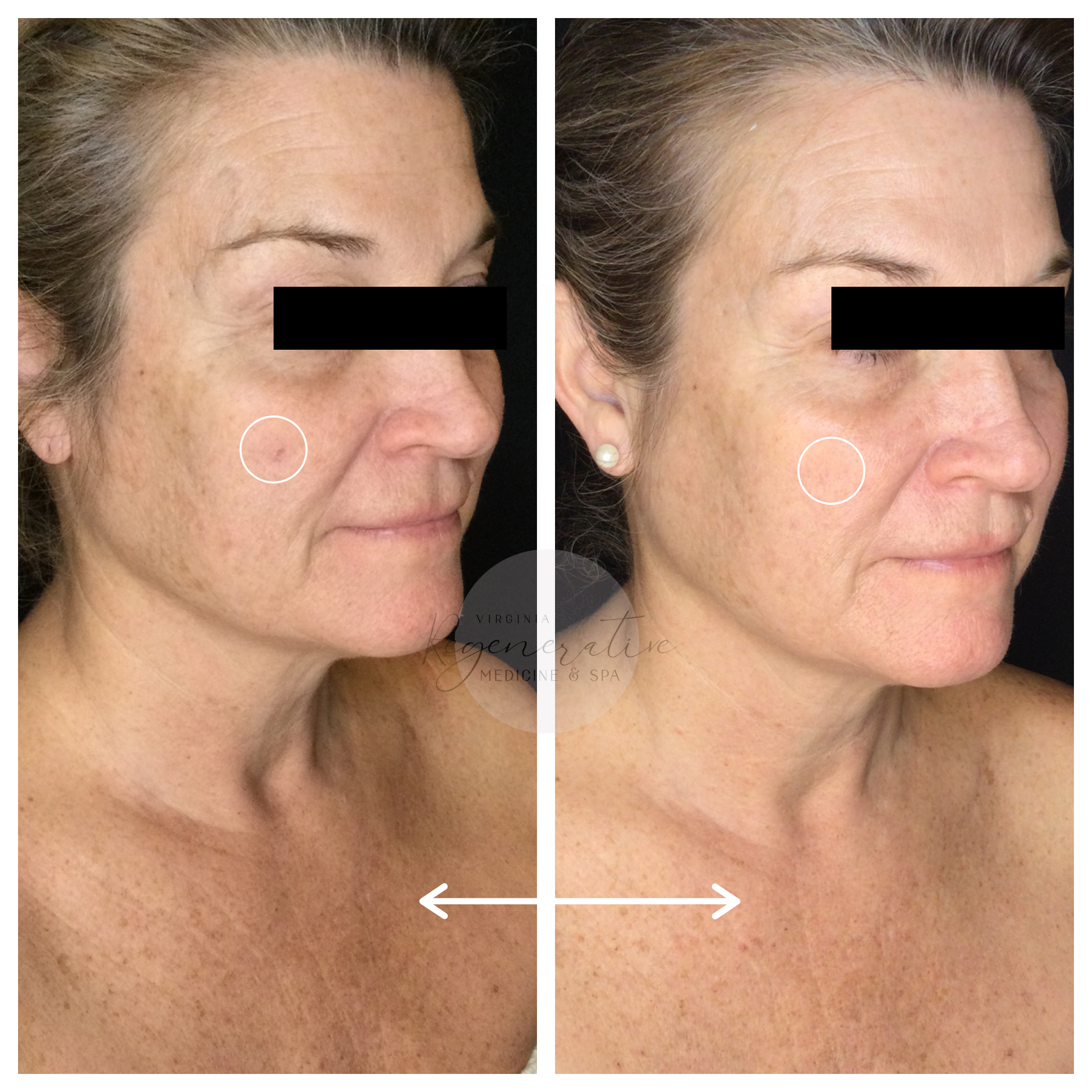 Microneedling with Exosomes 2 Weeks Before and After