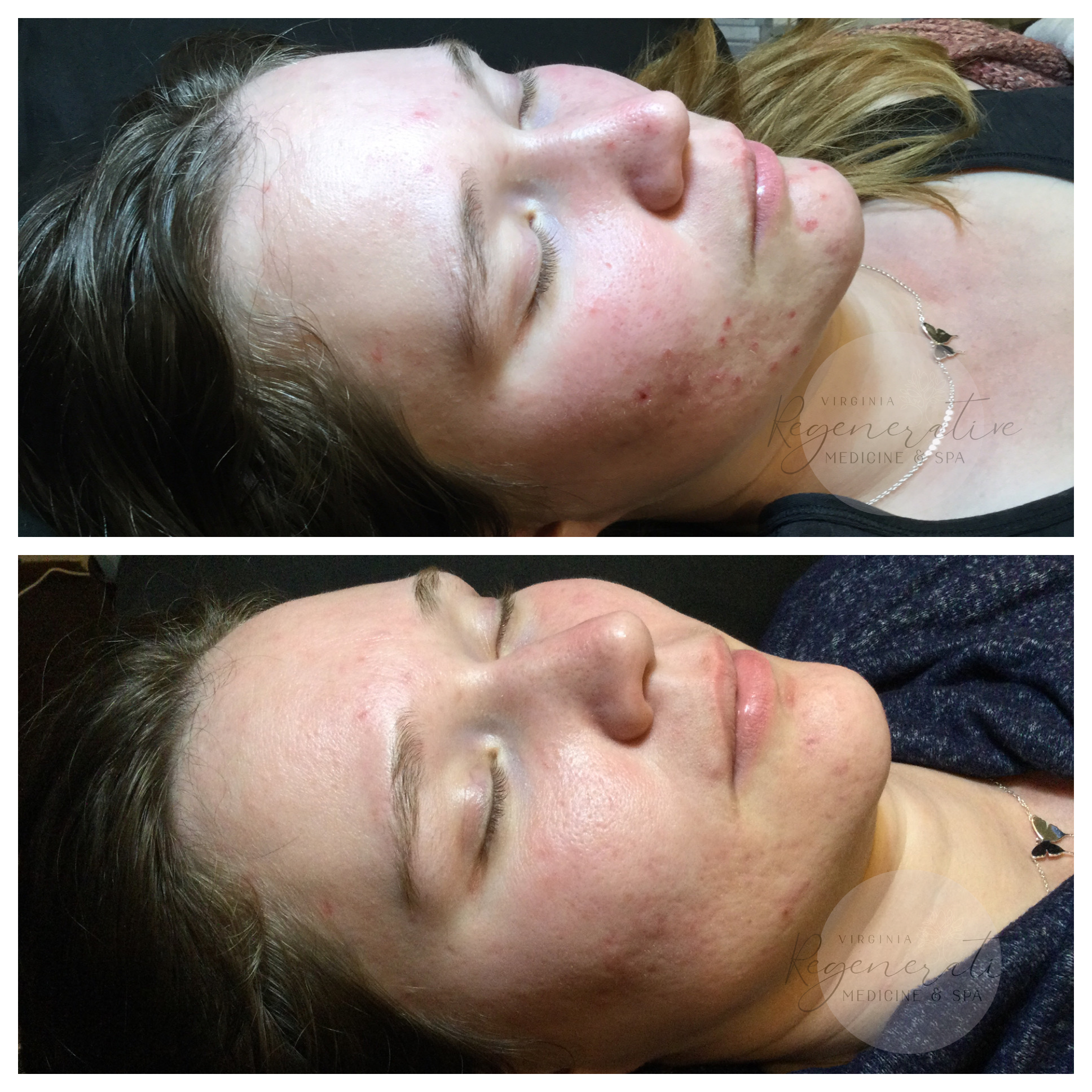 Series of Coco Enzyme Oxygen Facials