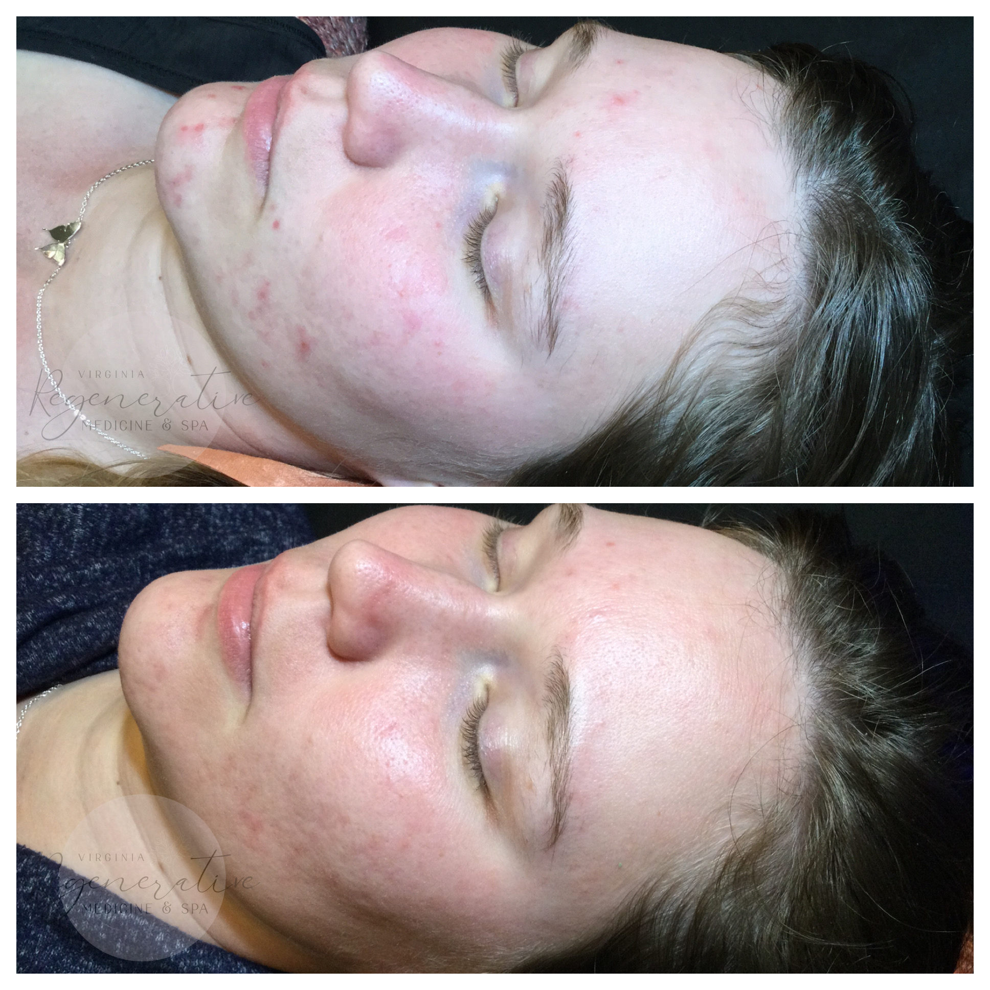 Series of Coco Enzyme Oxygen Facials