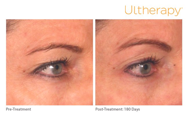 ultherapy_0221k-m_beforeandafter_brow_low-res.jpg