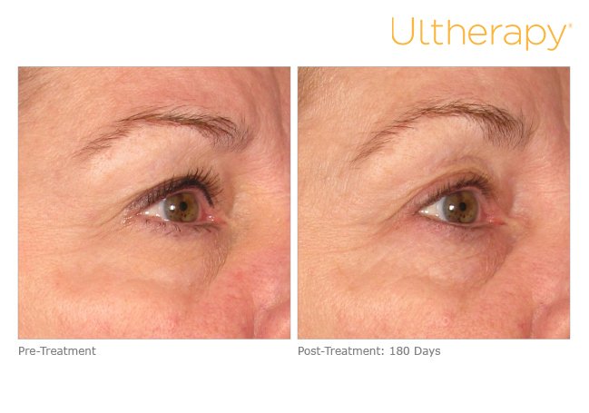 ultherapy-0013dlh_before-180daysafter_brow.jpg