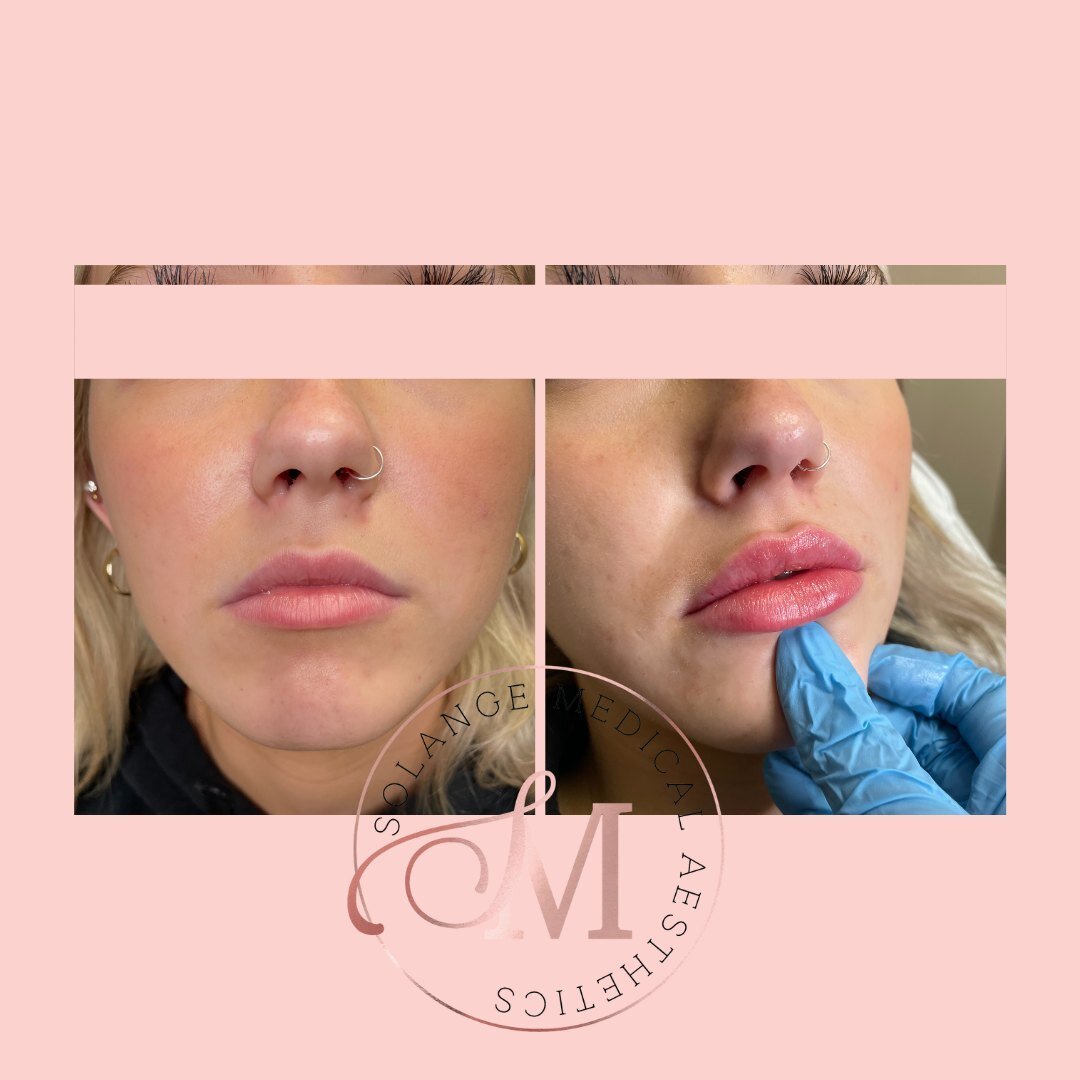 This transformation is everything😍!⁣
⁣
One syringe of @revanesse can make all the difference!⁣
⁣
Limited spots available before the holidays - call, text or DM to book!⁣
⁣⁣⁣⁣⁣⁣⁣⁣⁣⁣⁣⁣⁣⁣⁣
🤍⁣⁣⁣⁣⁣⁣⁣⁣⁣⁣⁣⁣⁣⁣⁣⁣⁣⁣⁣⁣⁣⁣⁣⁣⁣⁣⁣⁣⁣⁣⁣⁣⁣⁣⁣⁣⁣⁣⁣⁣⁣⁣⁣⁣⁣⁣⁣⁣⁣⁣⁣⁣⁣⁣⁣⁣⁣⁣⁣⁣⁣