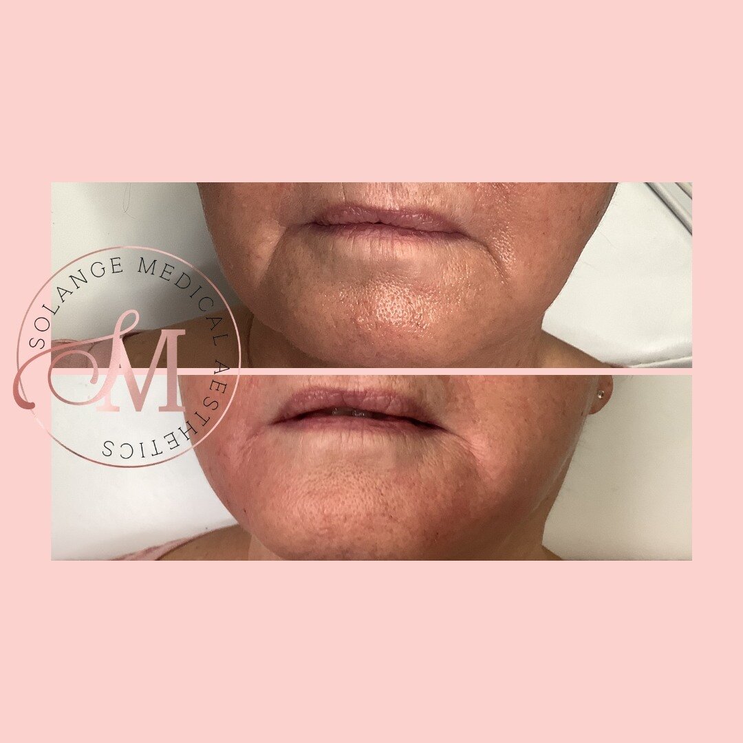 We are loving this marionette line transformation😍!⁣
⁣
For this look we used 2 syringes of @revanesse #ultra to reduce the appearance of the shallow vertical lines at the boom corners of her mouth.⁣
⁣
Do you have a trouble area that makes you self c