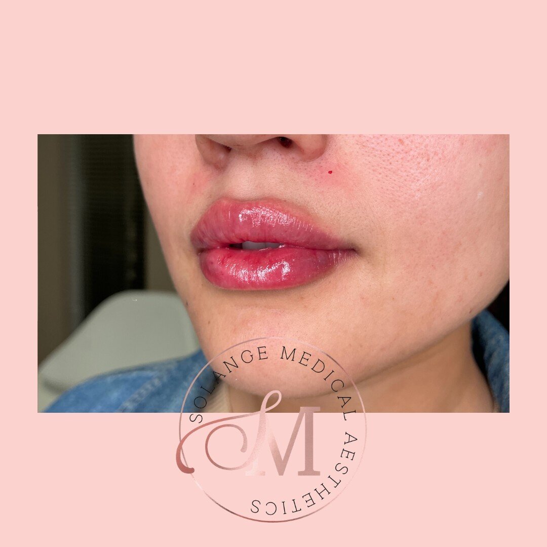 &ldquo;Lip injections look unnatural&rdquo; 🚩🚩🚩🚩⁣🚩🚩🚩
⁣
Here is proof lip injections can add volume to your lips without looking unnatural and if anyone tells you different, you don&rsquo;t need that negativity in your life🙅🏻&zwj;♀️!⁣
⁣
We us