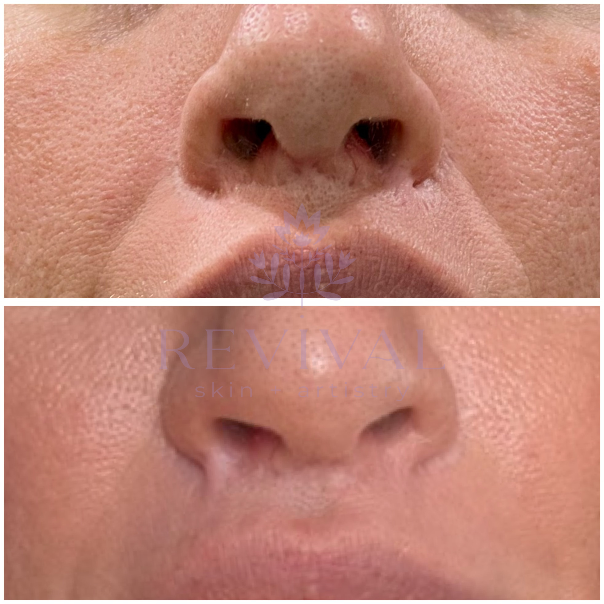 Scar Reduction Post-Lip Lift