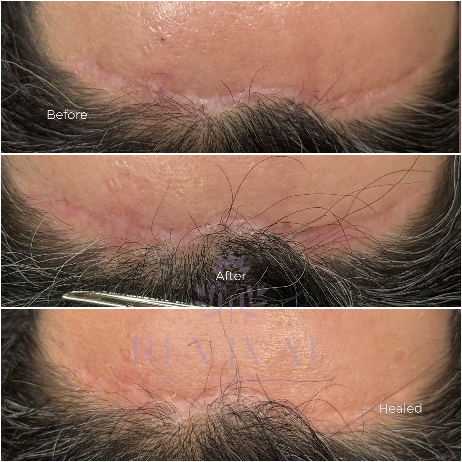 Scar Camouflage Forehead Lift